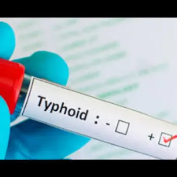  Typhoid Vaccine